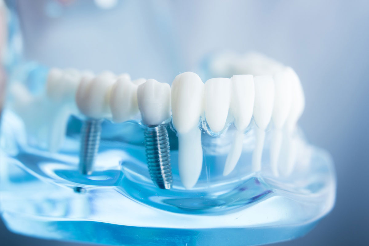 A close-up image of a dental model displaying a set of teeth.